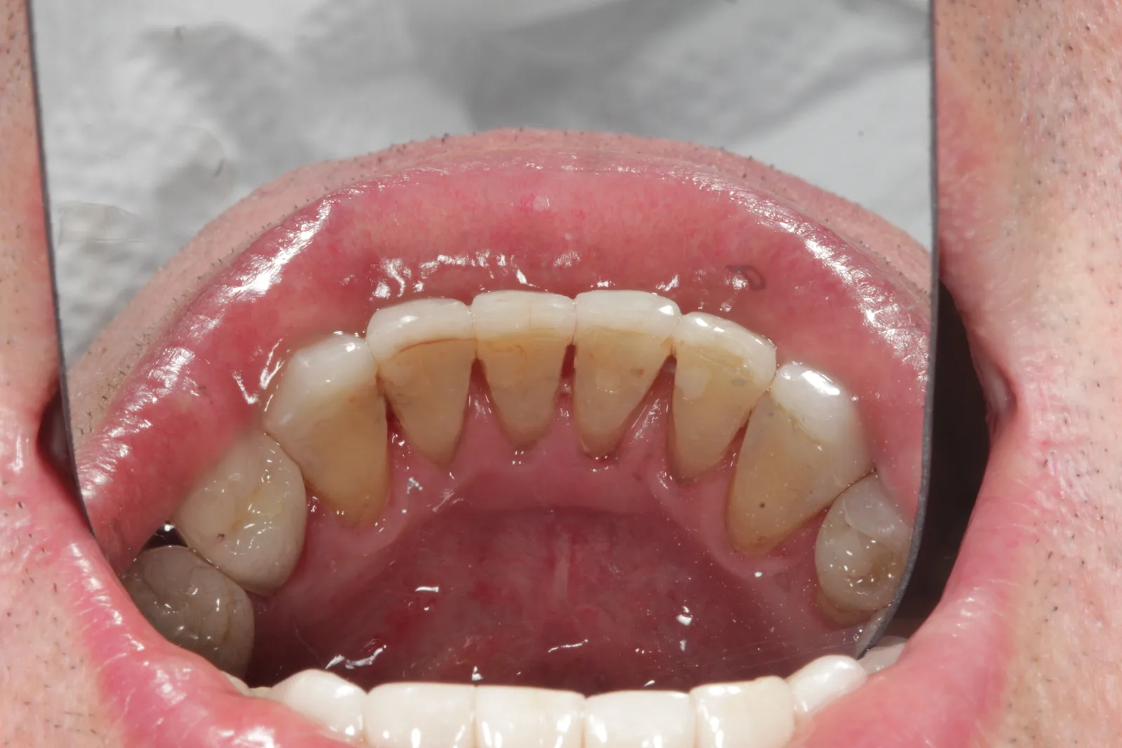 Face interna dos dentes inferiores com as superfícies livres de tártaro e polidas