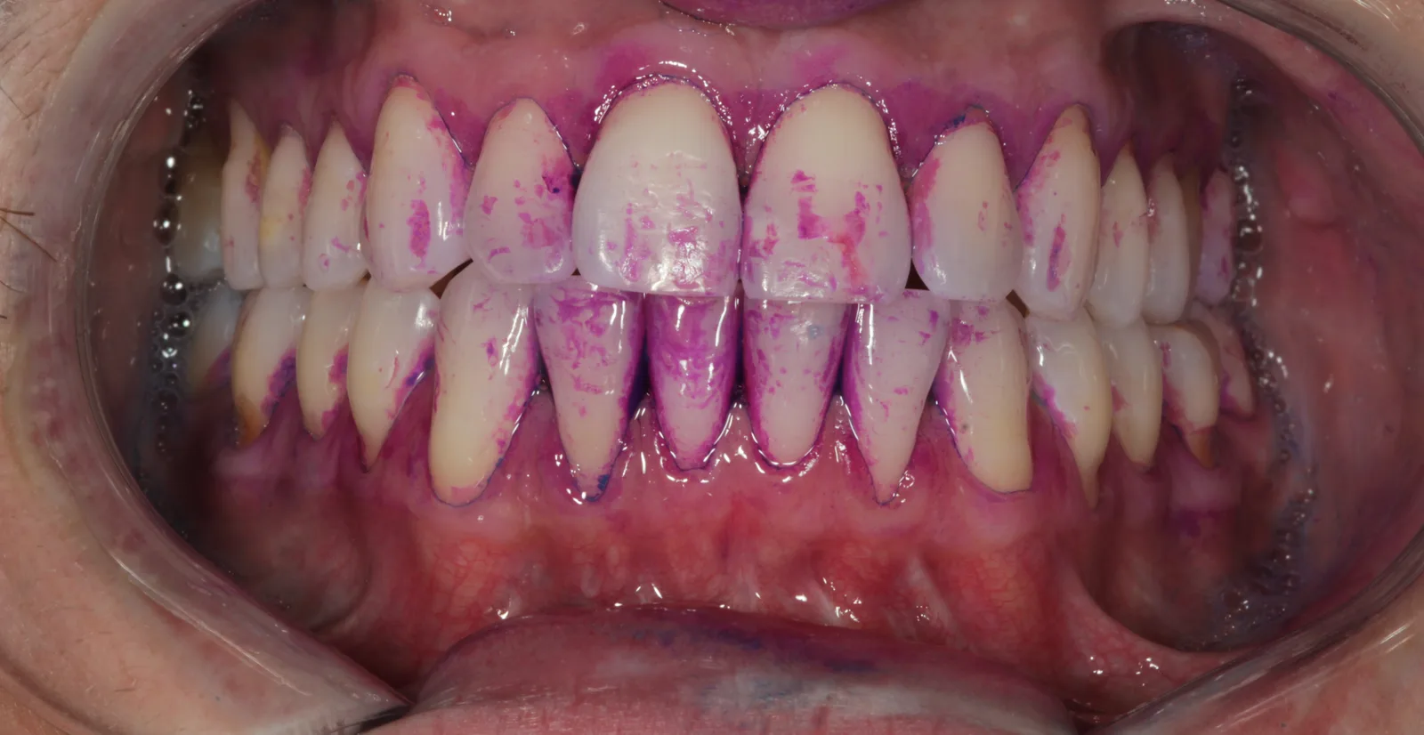 Arcadas coradas com evidenciador de placa: as áreas em tom rosa e roxo indicam acúmulo de placa bacteriana, concentrado na margem da gengiva e entre os dentes