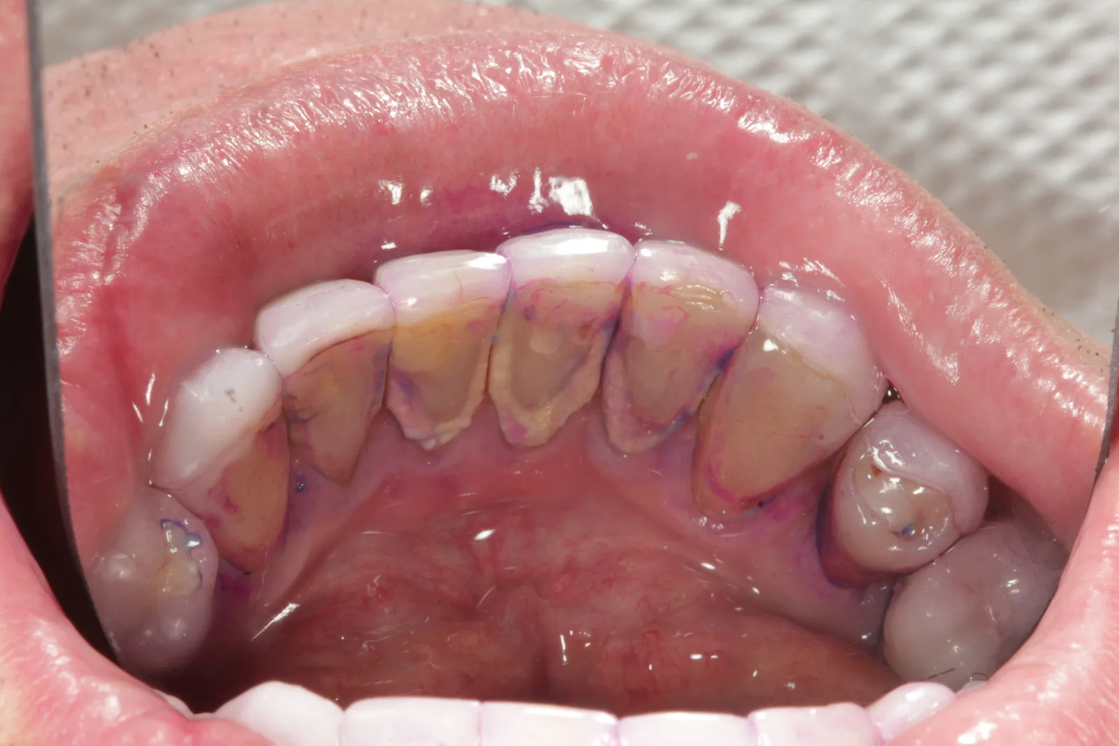 Face interna dos dentes inferiores com acúmulo de tártaro e placa corada pelo evidenciador na margem da gengiva