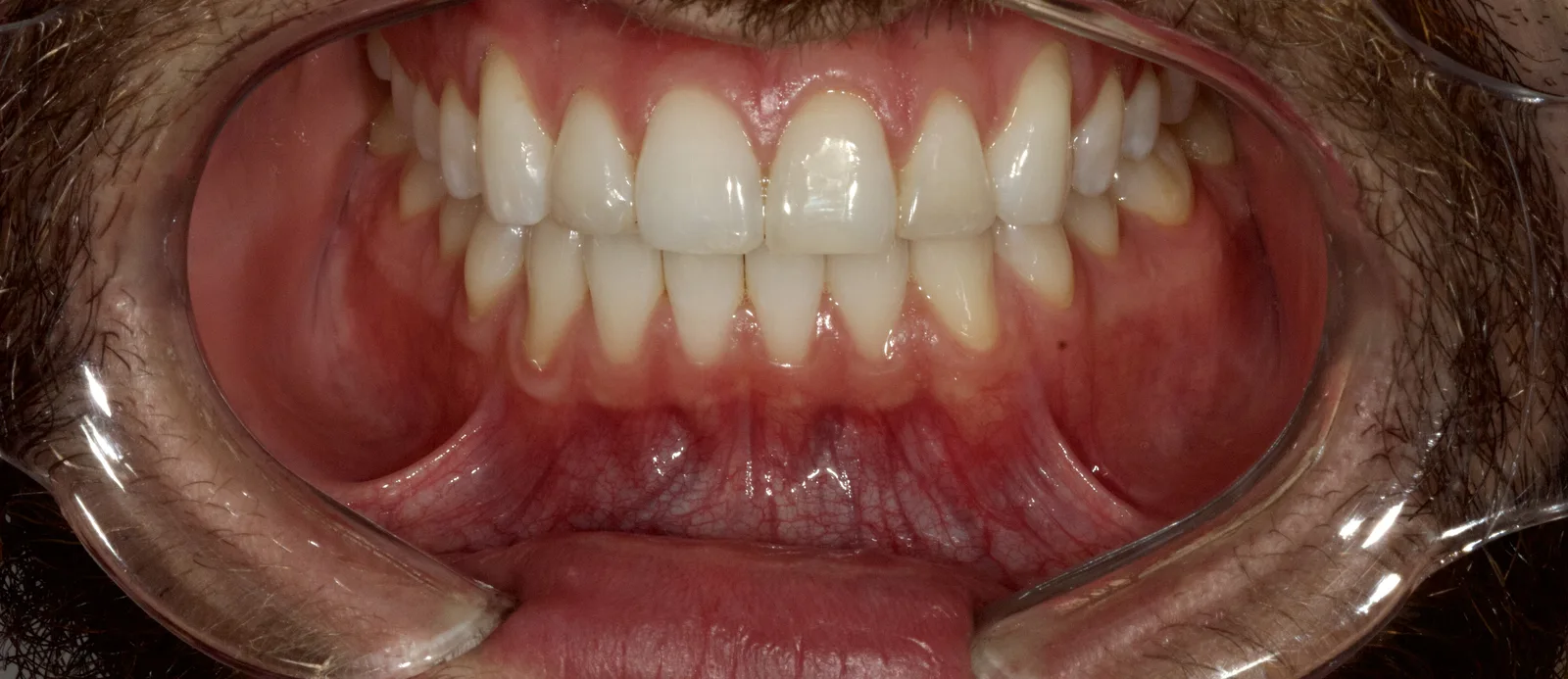 Arcadas em oclusão, com o contato entre os dentes superiores e inferiores restabelecido