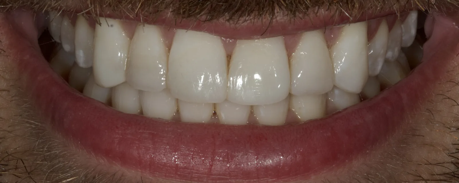 Dentes anteriores superiores com anatomia e comprimento restabelecidos