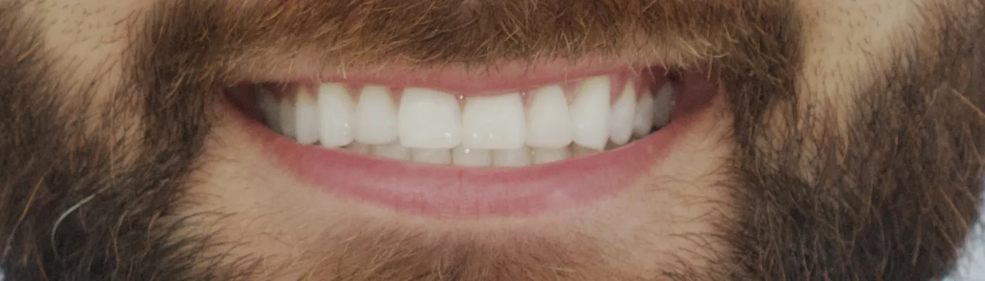 Sorriso natural com os dentes anteriores superiores recompostos em resina composta