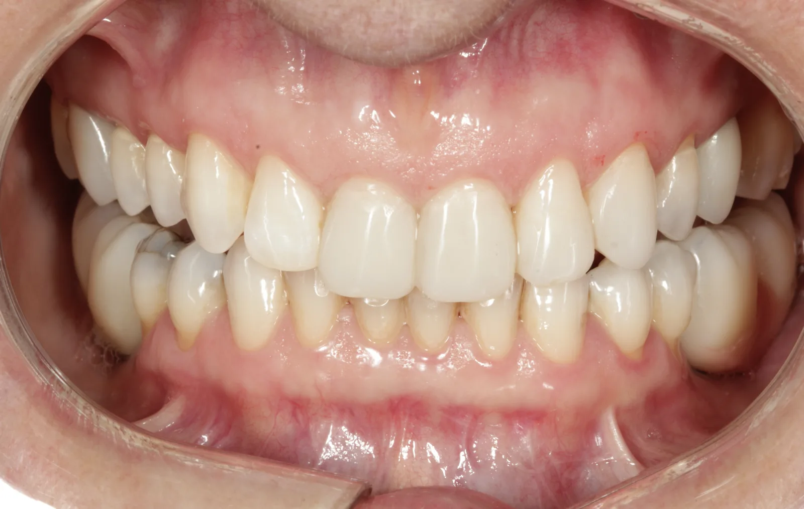 Dentes anteriores superiores com bordas regularizadas e proporção harmônica entre os elementos