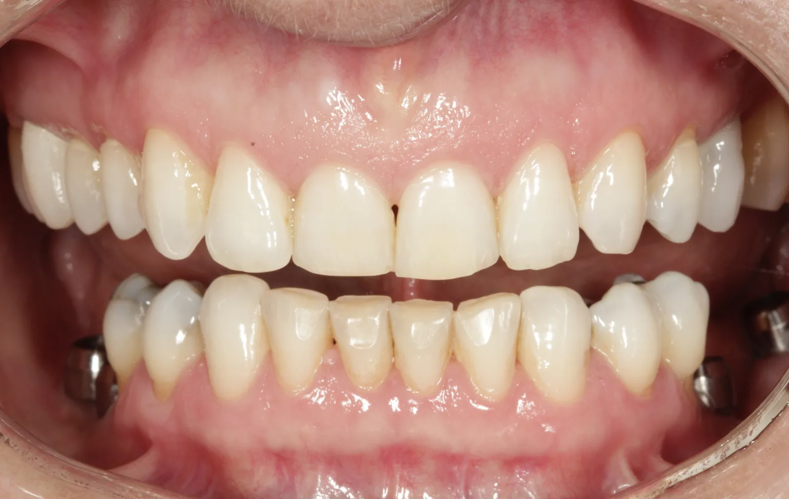 Dentes anteriores superiores com bordas irregulares, pequenas assimetrias e espaço entre os incisivos centrais
