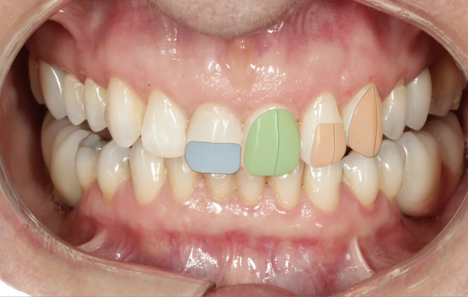 Fotografia do paciente com o planejamento do recontorno desenhado sobre os dentes, indicando as áreas onde a resina será adicionada